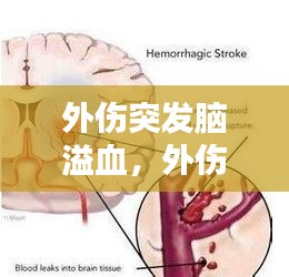 外伤突发脑溢血，外伤导致脑出血多久能恢复意识 