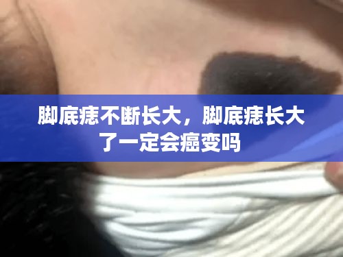 脚底痣不断长大，脚底痣长大了一定会癌变吗 